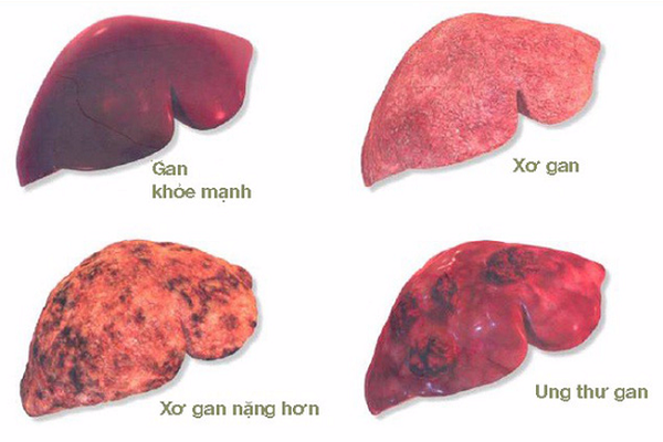 Khi đến giai đoạn viêm gan B mãn tính, nguy cơ bị xơ gan, ung thư gan là rất cao