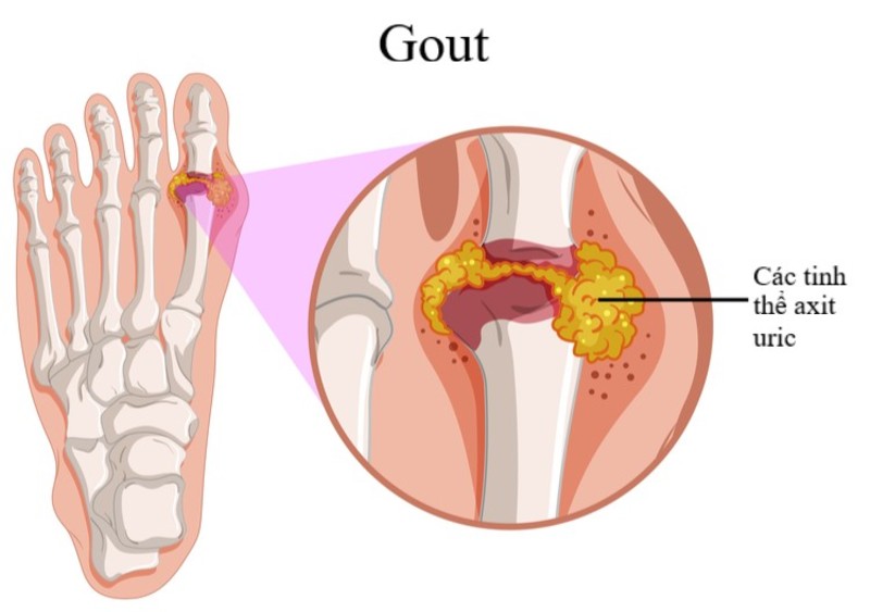 Các tinh thể urat hình thành gây phù nề 