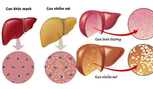 Hình ảnh gan khỏe mạnh, gan nhiễm mỡ và xơ gan độ 1