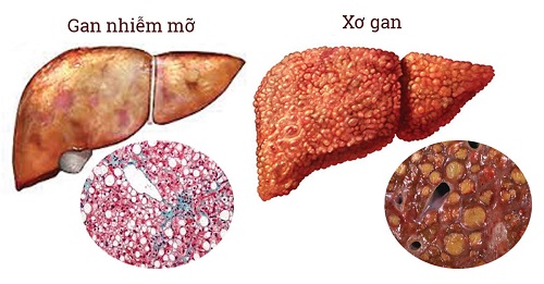 Triệu chứng của bệnh xơ gan độ 2