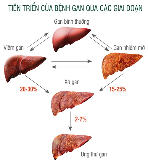 Sự tiến triển của bệnh xơ gan