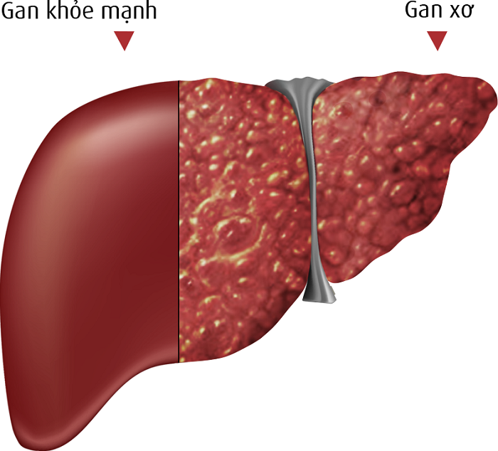 Mô phỏng bệnh xơ gan