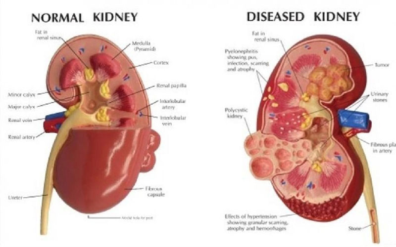 Suy thận mạn tính khá nguy hiểm