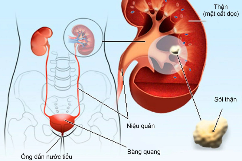 Cây ngò ôm được dân gian dùng để chữa bệnh sỏi thận