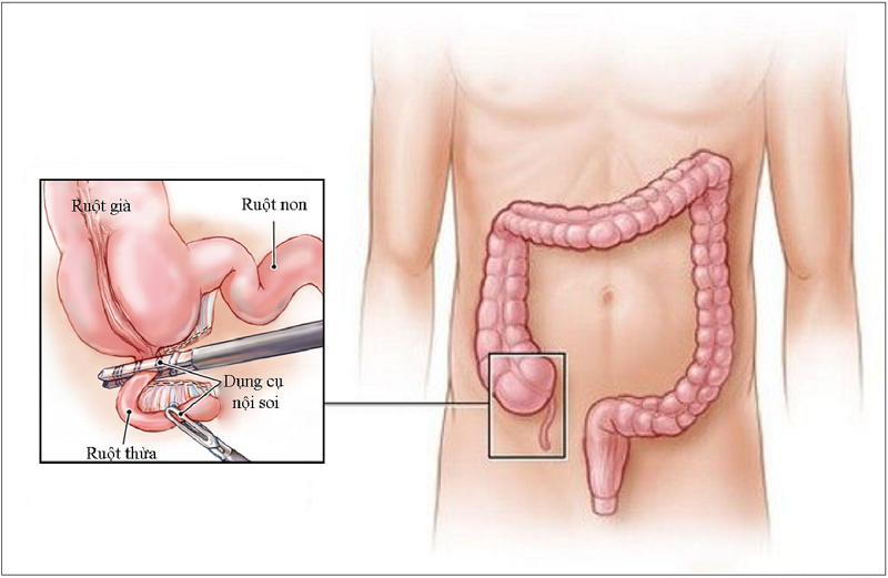 Mô phỏng phẫu thuật nội soi điều trị viêm ruột thừa cấp