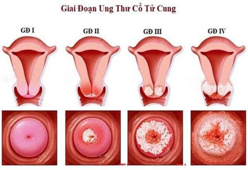 Ung thư cổ tử cung có thể gây tử vong