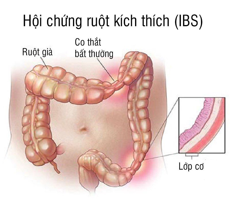 Hội chứng ruột kích thích là bệnh thường gặp ở ruột non