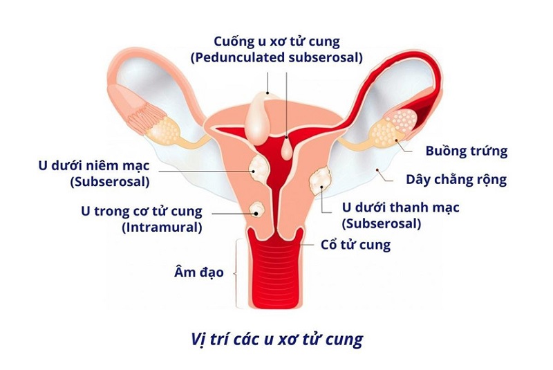 U xơ tử cung có thể xuất hiện ở nhiều vị trí khác nhau