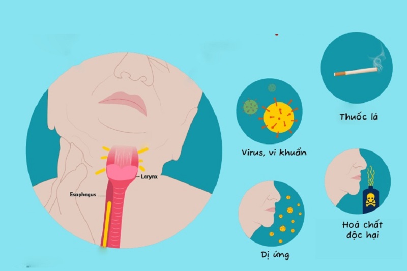 Một số nguyên nhân thường gặp dẫn đến hiện tượng đau họng