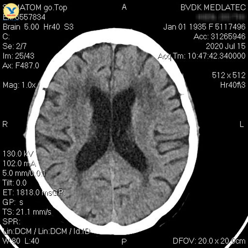 Phim chụp CT vùng sọ não hỗ trợ quá trình chẩn đoán 