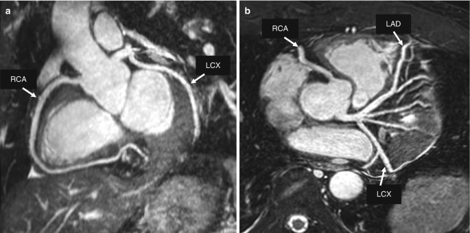 chụp MRI mạch vành