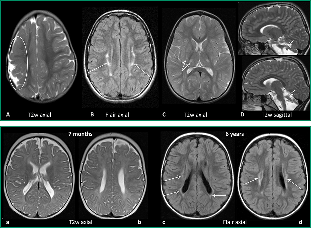 chụp MRI não cho trẻ em