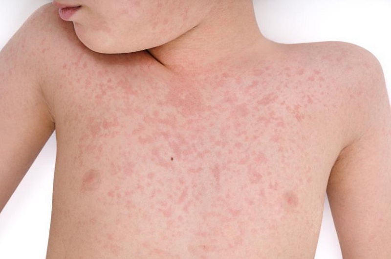 Virus Rubella chỉ xuất hiện trên cơ thể người