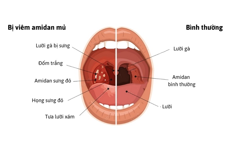 Nhận diện viêm amidan hốc mủ bã đậu