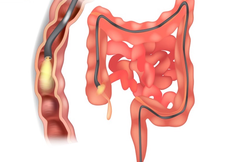 Thiết bị nội soi có thể giúp ghi lại rõ nét các hình ảnh bên trong đại tràng