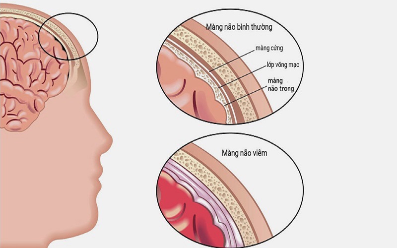 Bệnh viêm màng não có thể gây ra triệu chứng sốt đau đầu