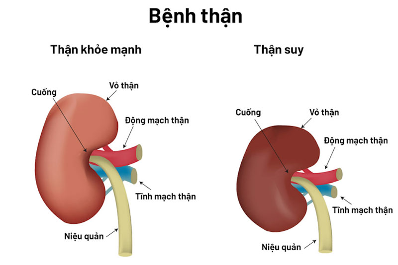 Suy thận là bệnh suy giảm chức năng của thận