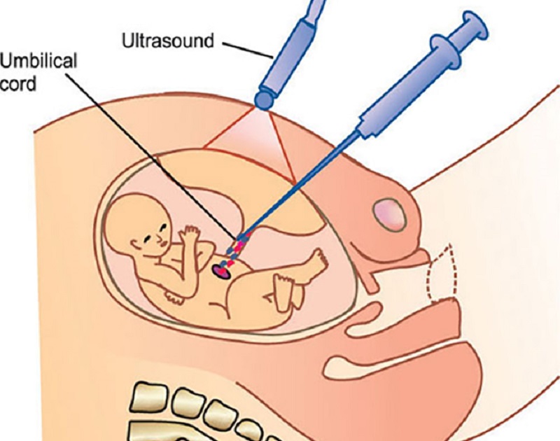 Mô phỏng phương pháp chẩn đoán trước sinh bằng chọc máu cuống rốn