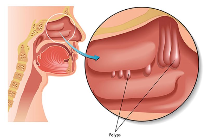 Một bên cánh mũi bị sưng có thể do sự hình thành của khối polyp mũi