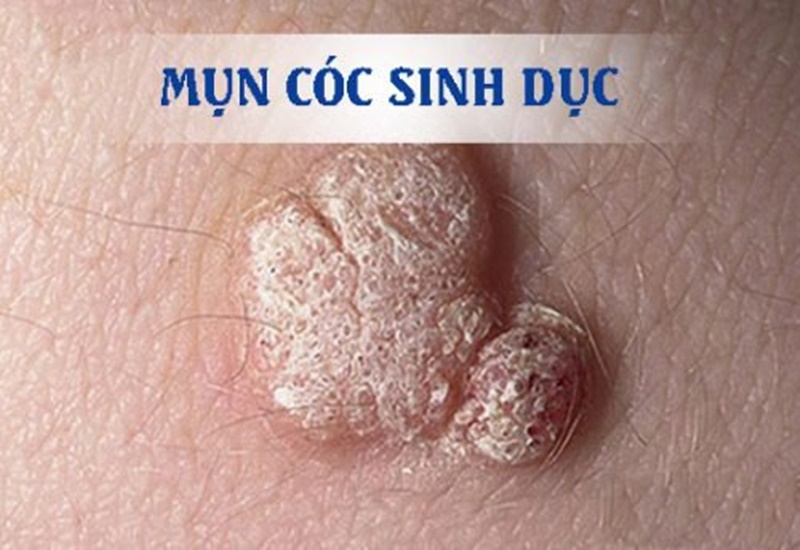 Mụn cóc sinh dục do HPV gây ra