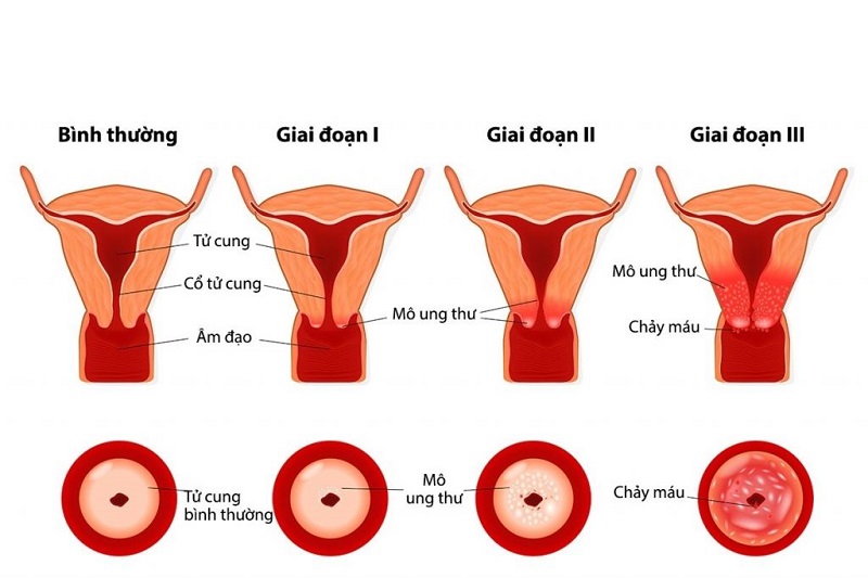 Tiến triển bệnh ung thư cổ tử cung qua các giai đoạn
