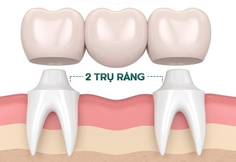 Làm cầu răng sứ