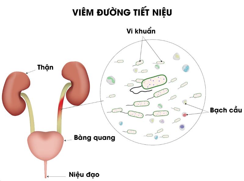 Vi khuẩn E.coli là tác nhân chủ yếu gây viêm đường tiết niệu