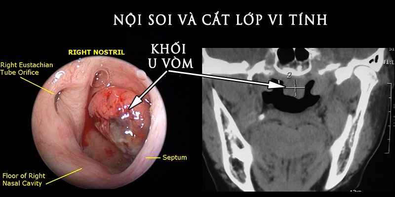 Nội soi và chụp cắt lớp giúp chẩn đoán ung thư vòm họng