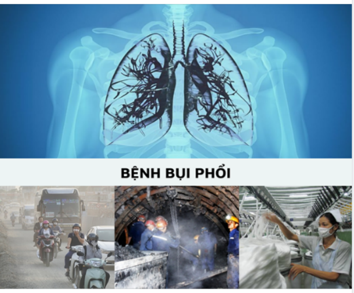 bụi phổi nghề nghiệp