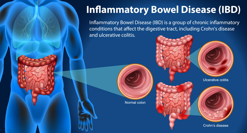 Viêm đường ruột gồm: viêm ruột kết và bệnh Crohn