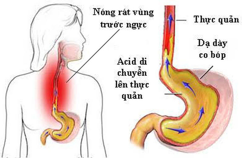 Niêm mạc thực quản bị tổn thương khi tiếp xúc với axit gây phù nề