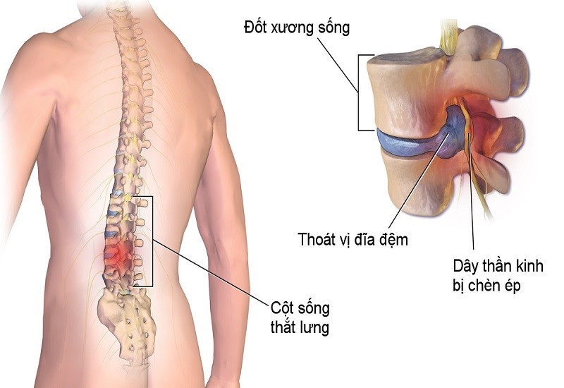 chụp MRI thoát vị đĩa đệm