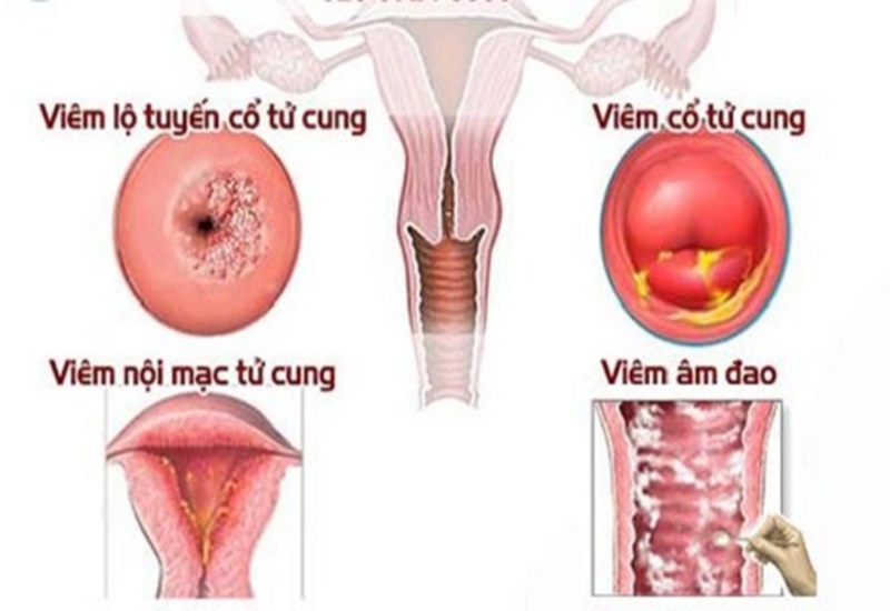 Chậm kinh có thể do bệnh phụ khoa