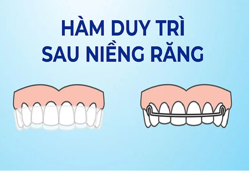 Cần dùng hàm duy trì sau niềng răng