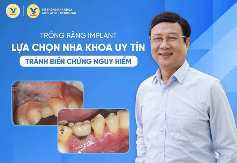 Quý khách hàng có thể hoàn toàn yên tâm khi trồng răng tại MedDental