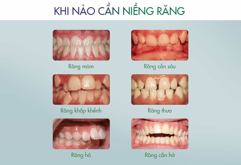 Nếu răng bị hô và khấp khểnh khểnh thì bạn nên niềng răng sớm