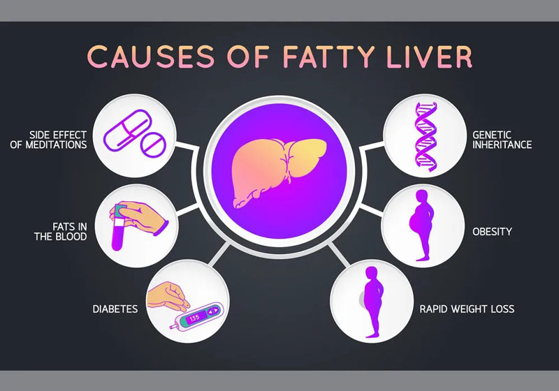 Có nhiều yếu tố khiến bệnh lý gan nhiễm mỡ hình thành