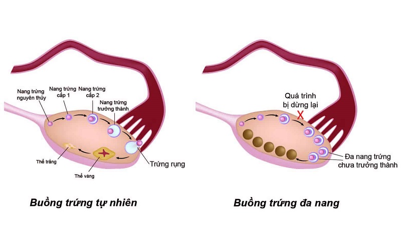 Xét nghiệm AMH giúp đánh giá đúng về dự trữ buồng trứng và đa nang buồng trứng