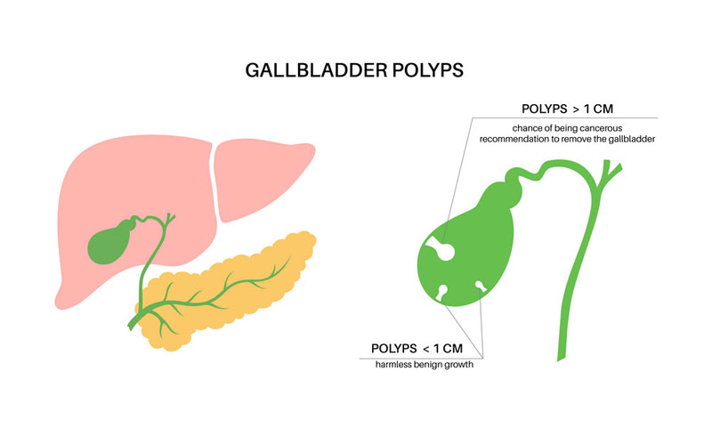 Polyp lớn sẽ được chỉ định cắt bỏ