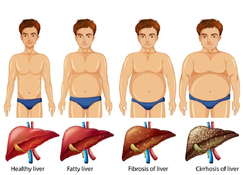 Chỉ số men gan là yếu tố phản ánh tình trạng sức khỏe của gan