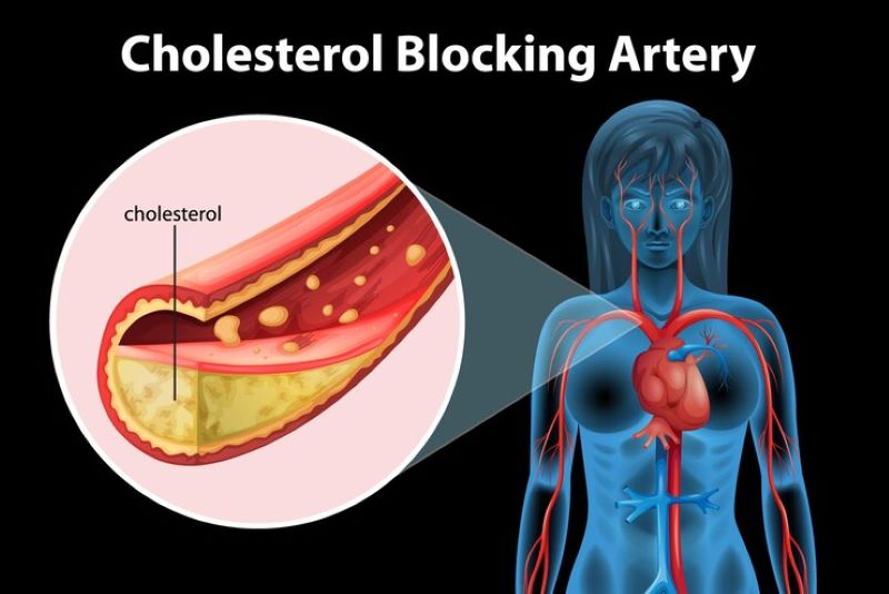 Cholesterol xấu tăng cao hình thành mảng bám gây cản trở mạch máu