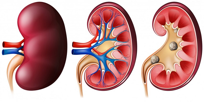 Cây bòng bong có thể dùng để chữa một số bệnh lý ở thận