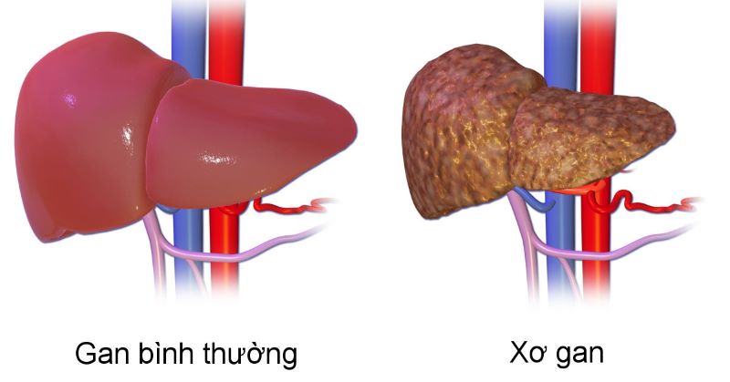 Tùy mức độ xơ hóa gan mà triệu chứng của bệnh sẽ khác nhau