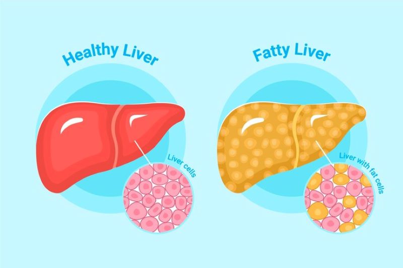 Mỡ tích tụ quá nhiều gây cản trở chức năng gan