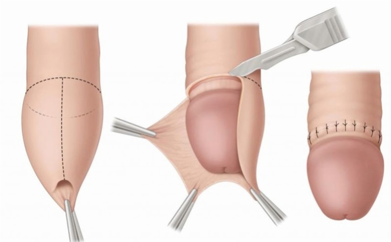 Cắt bao quy đầu là tiểu phẫu khá đơn giản, được thực hiện nhanh chóng