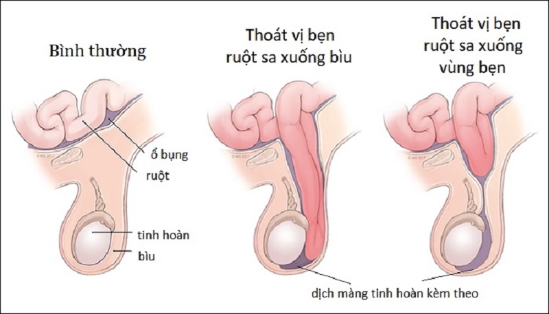 Mô phỏng giúp hình dung về thoát vị bẹn