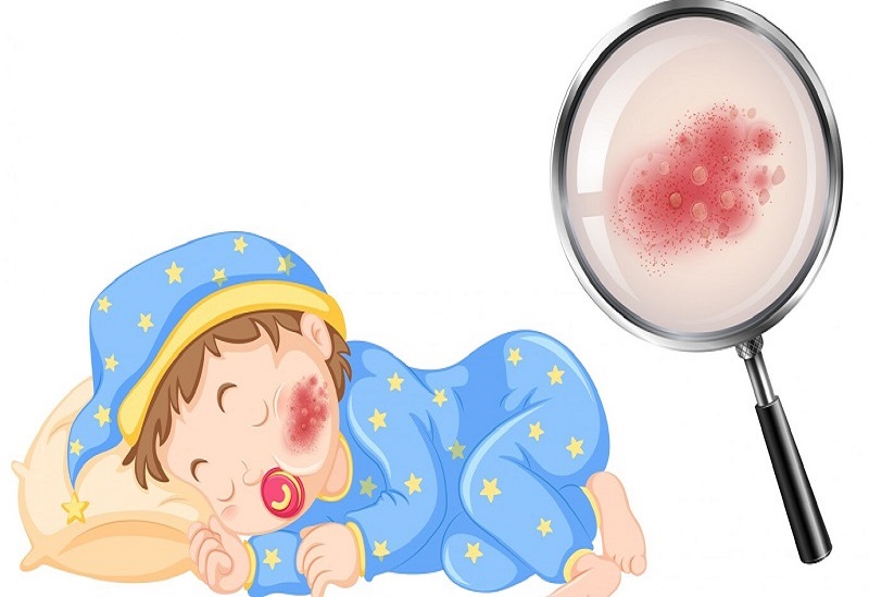 Trẻ bị tay chân miệng là do nhiễm phải nhóm virus Enterovirus