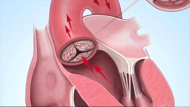 Hẹp hay hở van bán nguyệt sẽ dẫn đến rối loạn hoạt động bơm máu từ tim