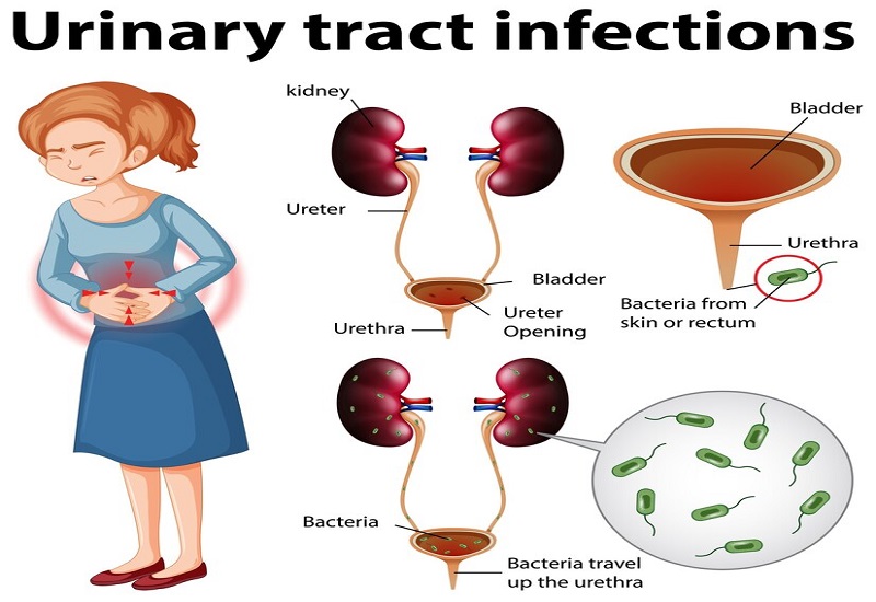 Nhiễm khuẩn đường tiết niệu khiến nữ giới bị đau vùng chậu