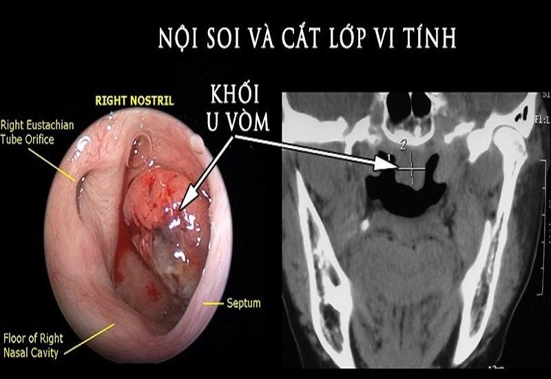 Chụp ct vòm họng